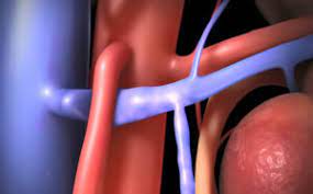 vascular ultrasound nutcracker syndrome renal vein compressed superior mesenteric artery pain blood urine pelvic abdomen left
