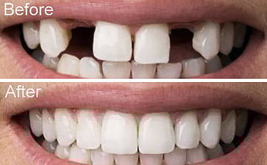 affordable dental implants in mexico