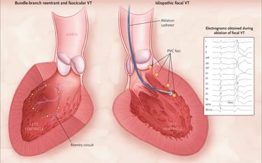Ventricular Tachycardia-Meaning Causes, Treatment and catheter Ablation for VT