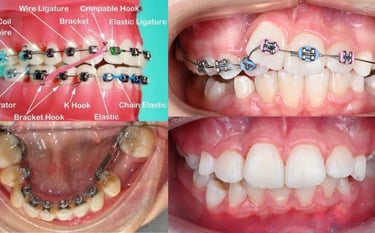 Entdecken Sie die 10 wichtigsten, wissenschaftlich belegten Vorteile von Zahnspangen, bestätigt von 