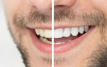 Bleaching Diş Beyazlatma