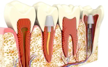 root canal step step explaination