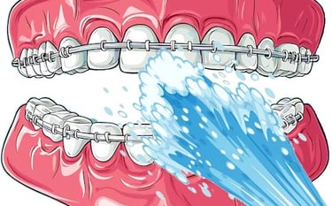 Nettoyer appareil orthodontique avec jet dentaire ozone Aquolab hygiene-precision.com