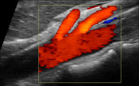 vascular ultrasound mesenteric abdomen pain food weight loss nausea vomiting blood stool ischaemia bowel blockage artery