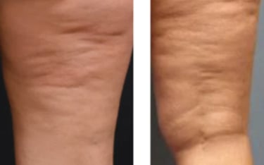 le massage brésilien : un massage anti cellulite