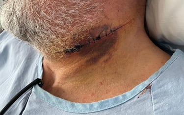 Detalle de secuelas en cuello de Andrés Román en Gandía que se relatan en la novela Sin lealtad, la