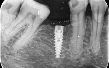 implantologie, implante timisoara