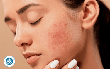 Pimple Acne