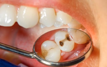 tratament carii dentare timisoara