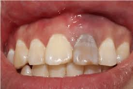 a image showing yellow stain on teeth