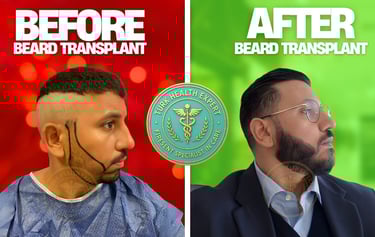 foto de y despues de trasplante de barba