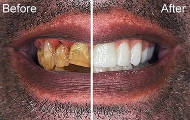 all-on-4-dental-procedure-in-mexico