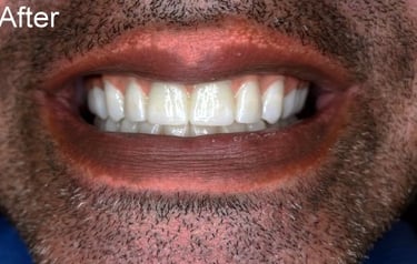Pretteau Zirconia Superstructure