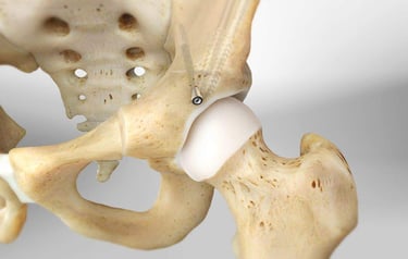 Osteotomia Periacetabular Berna Ganz