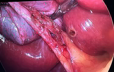 realizando a cirurgia de calculos biliares