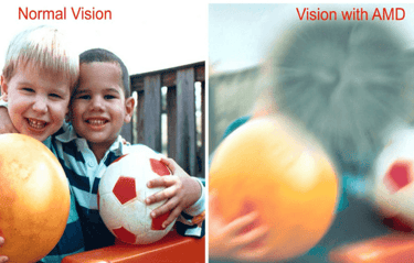 Vision with AMD Age Related Macular Degeneration ARMD