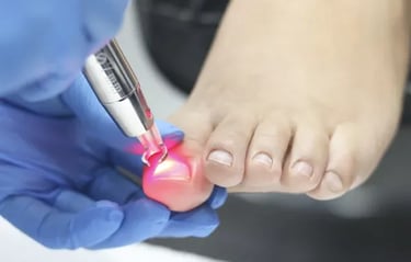 Tratamiento-Laser-Onicomicosis