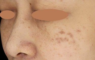 horis nevus hyperpigmentation singapore