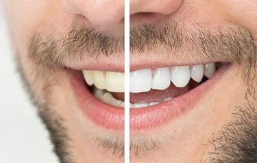 Bleaching Diş Beyazlatma