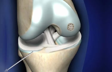 Dr.Rajinikanth's ortho clinic loose bodies