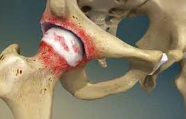 Dr.Rajinikanth's ortho clinic arthritis/ osteoarthritis of hip