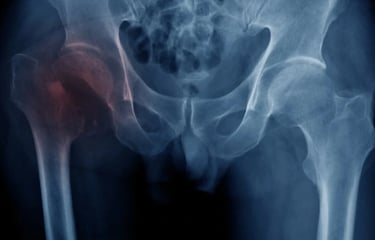 Dr.Rajinikanth's ortho clinic avulsion fracture