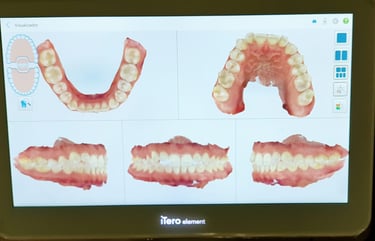 Scanner iTero usado em avaliação ortodôntica para Invisalign por dentista na Lapa PR.