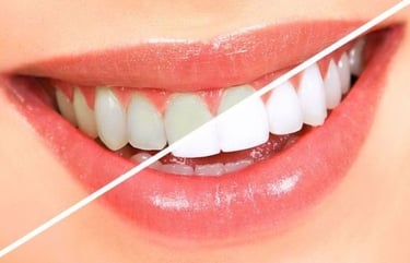 Resultado de antes e depois do clareamento dental na Vidaclin, clínica na Lapa PR.