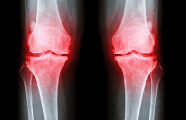 a pair of knee joint x ray image knee pain in OA