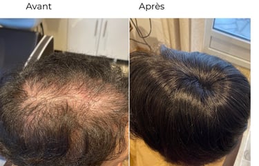 complément capillaire pas de calais