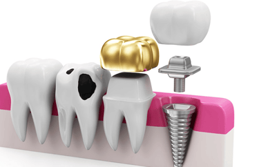 restorative dental procedures