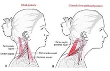 Diagram comparing ideal posture with chronic forward head posture and neck muscle tension.