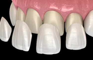 Facetas e lentes do contato odontológico para melhorar a estetica do sorriso