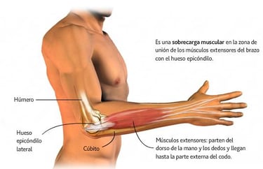 Epicondilitis o codo de tenista