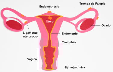 Endometriosis endometrio ovario trompa de falopio imujer ginecología murcia ligamento uterosacro