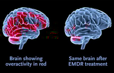 EMDR does not re-traumatise like exposure therapy. The sufferer does not have to re-live the events.