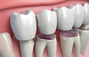 Dental Crowns & Bridges Greater Noida