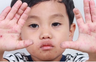 infeksi kulit pada anak