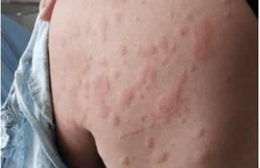 Penyakit kulit gatal alergi