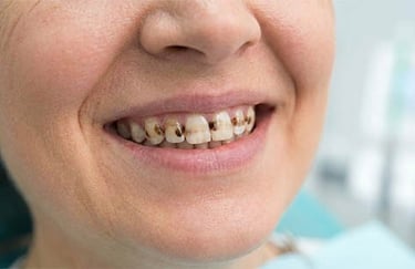 Taches brunes et noires sur les dents hygiene-precision.com
