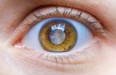 Cataract Eye