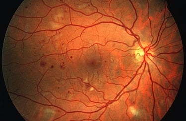 Diabetic Retinopathy