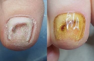 traumuotas nagas protezavimas