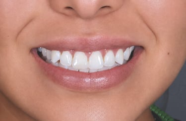 Paciente con sonrisa blanca después de tratamiento de blanqueamiento dental realizado por el Dr. Leo