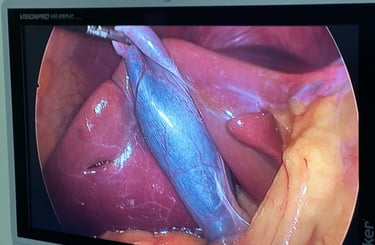 imagem da camera de videolaparoscopia