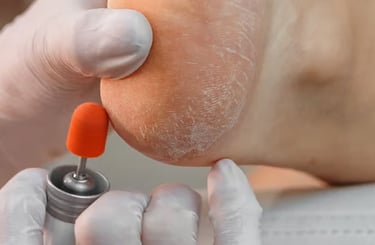 Fissuras e Rachaduras nos Pés | Talitha Miquelanti - Podóloga em Uberlândia | Podologia em Uberlândi