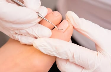 Unha Encravada | Talitha Miquelanti - Podóloga em Uberlândia | Podologia em Uberlândia