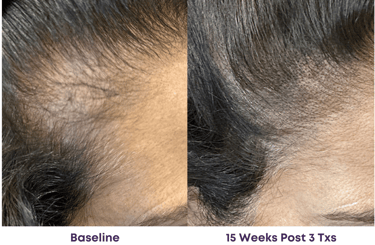 thicker and fuller hair 15 weeks after 3 TED treatments