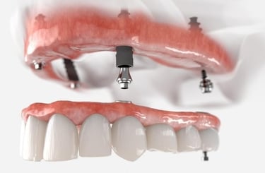All-on-4 procedure