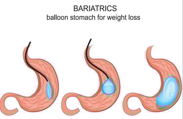 gastric ballon